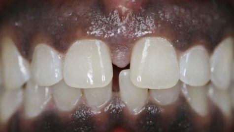 Close up of imperfect smile before cosmetic bonding