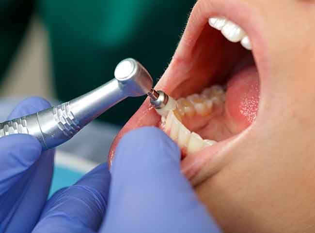 Closeup of blue gloved fingers polishing a patient’s teeth with special intrsument