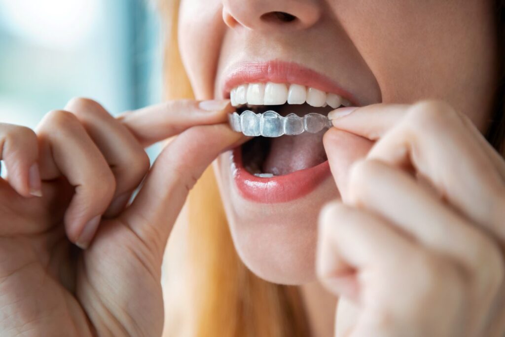 A woman putting on an Invisalign aligner.